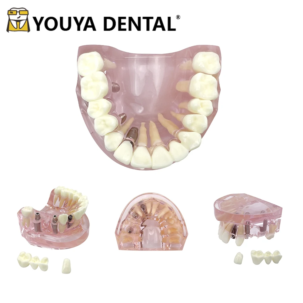 Стоматологическая модель зубов с имплантами Overdenture, улучшенная демонстрационная верхняя челюсть, съемная модель зубов для обучения обучению