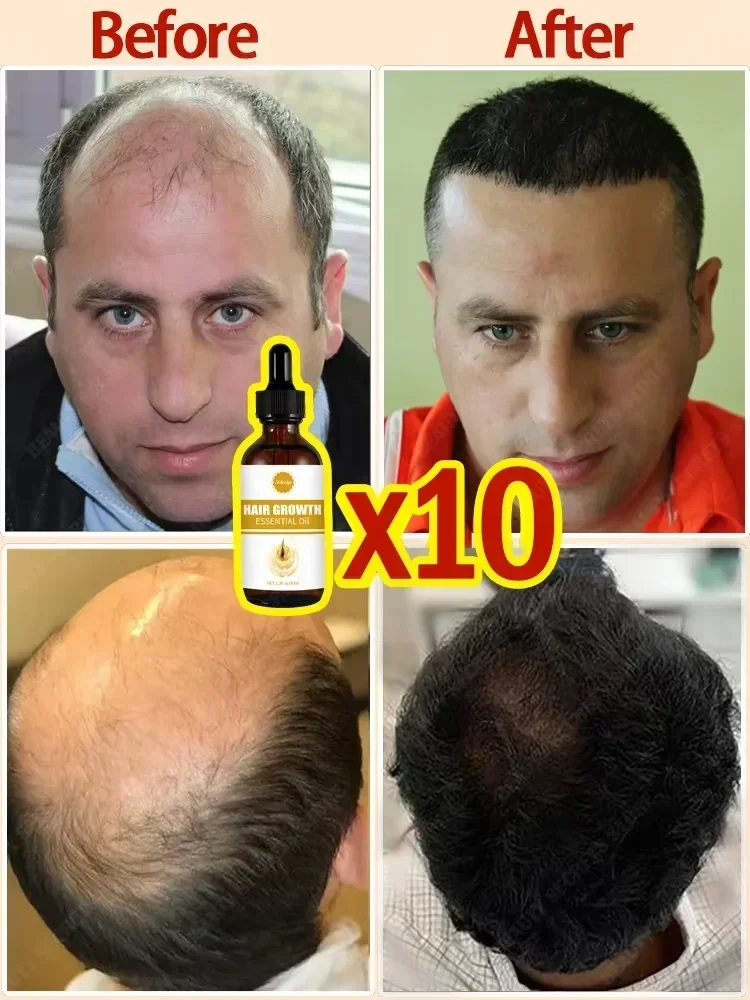 Фото Óleo de crescimento rápido do cabelo para produtos homens mulheres №4