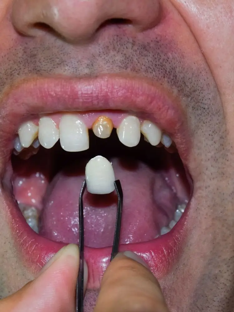 Фото Yucera Shade A2 размер 5 шт./Pk дисиликат лития IPS e.max CAD CEREC C14 LT HT Block №3