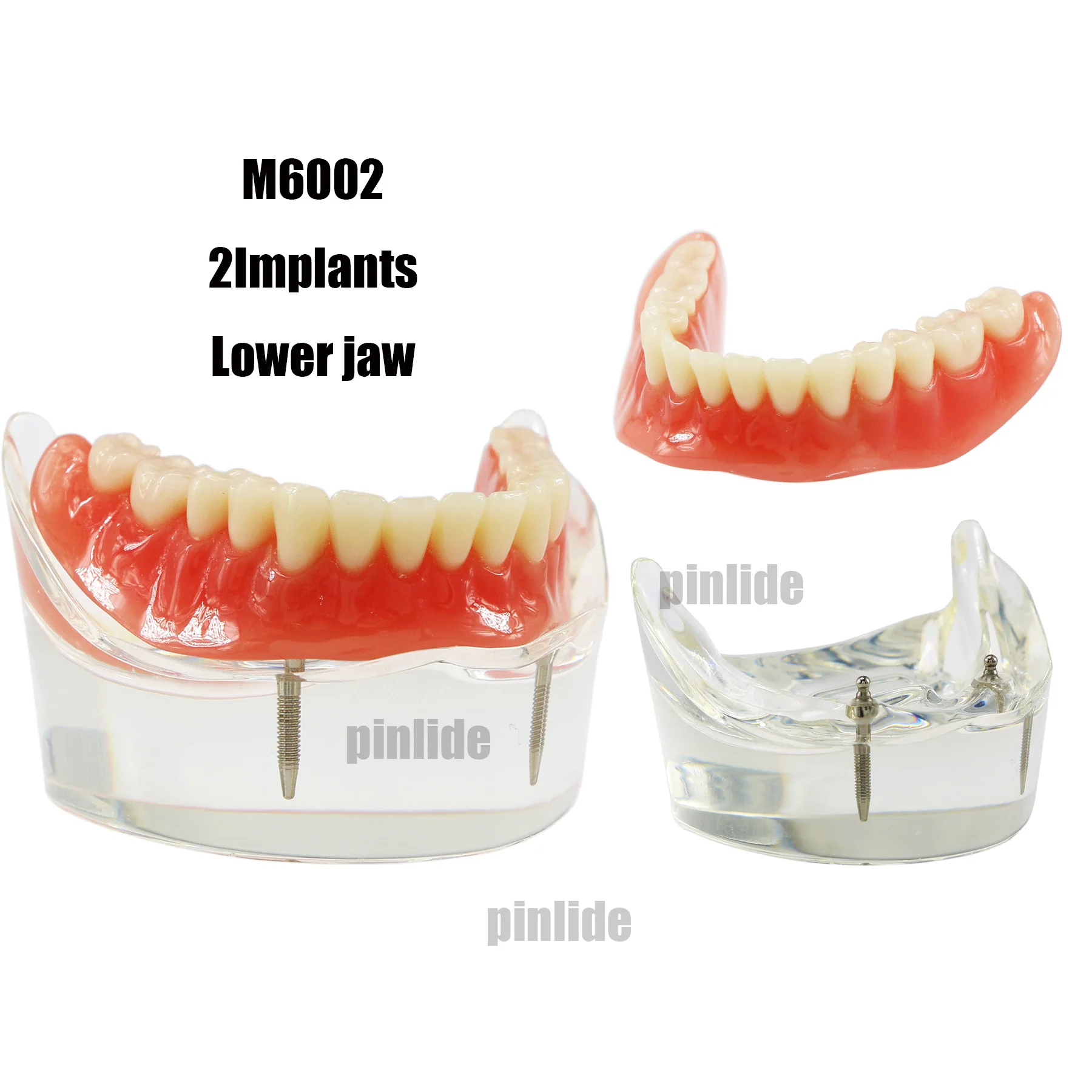 Модель зубного имплантата Overdenture Inferior 2, имплантаты для нижних зубов, демонстрационное исследование M6002