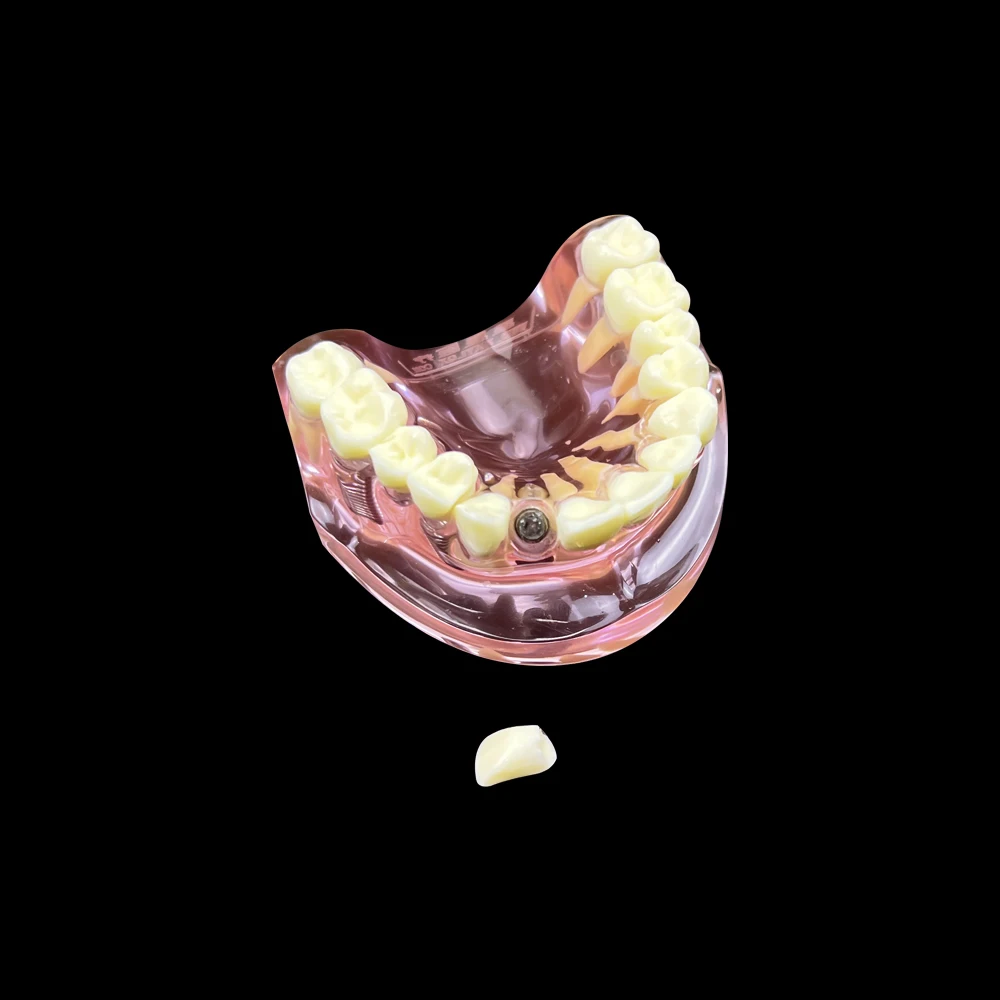Фото Стоматологическая модель зубов с имплантами Overdenture, улучшенная демонстрационная верхняя челюсть, съемная модель зубов для обучения обучению №4