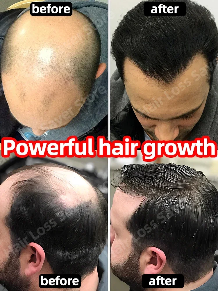 O óleo de crescimento capilar faz o cabelo crescer rapidamente, repara eficazmente a calvície e a queda de cabelo hereditária