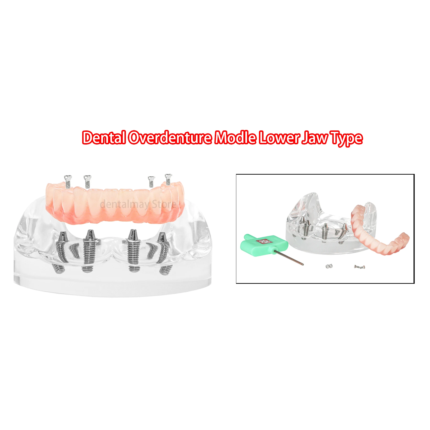 Фото Зубной имплантат Overdenture All-on-4 Модель Верхняя/нижняя челюсть - прозрачный с 4 винтами №4