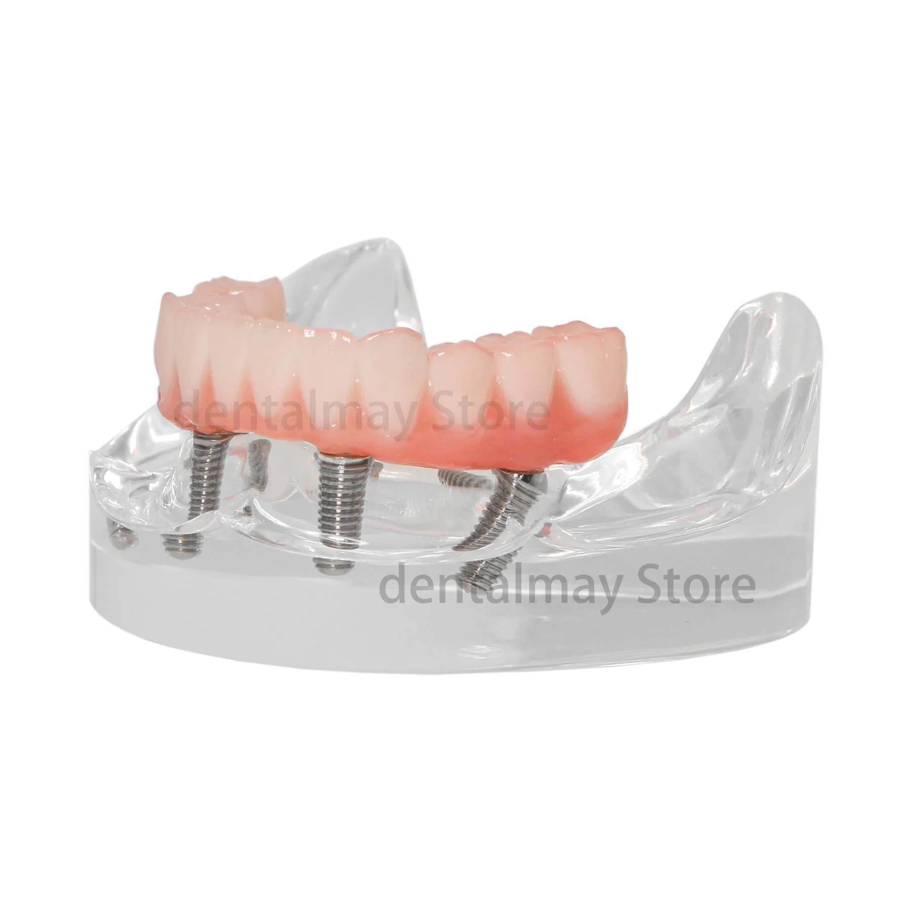 Зубной имплантат Overdenture All-on-4 Модель Верхняянижняя челюсть - прозрачный с 4 винтами (art.: 3920cc5dd4f3d) - 3920cc5dd4f3d