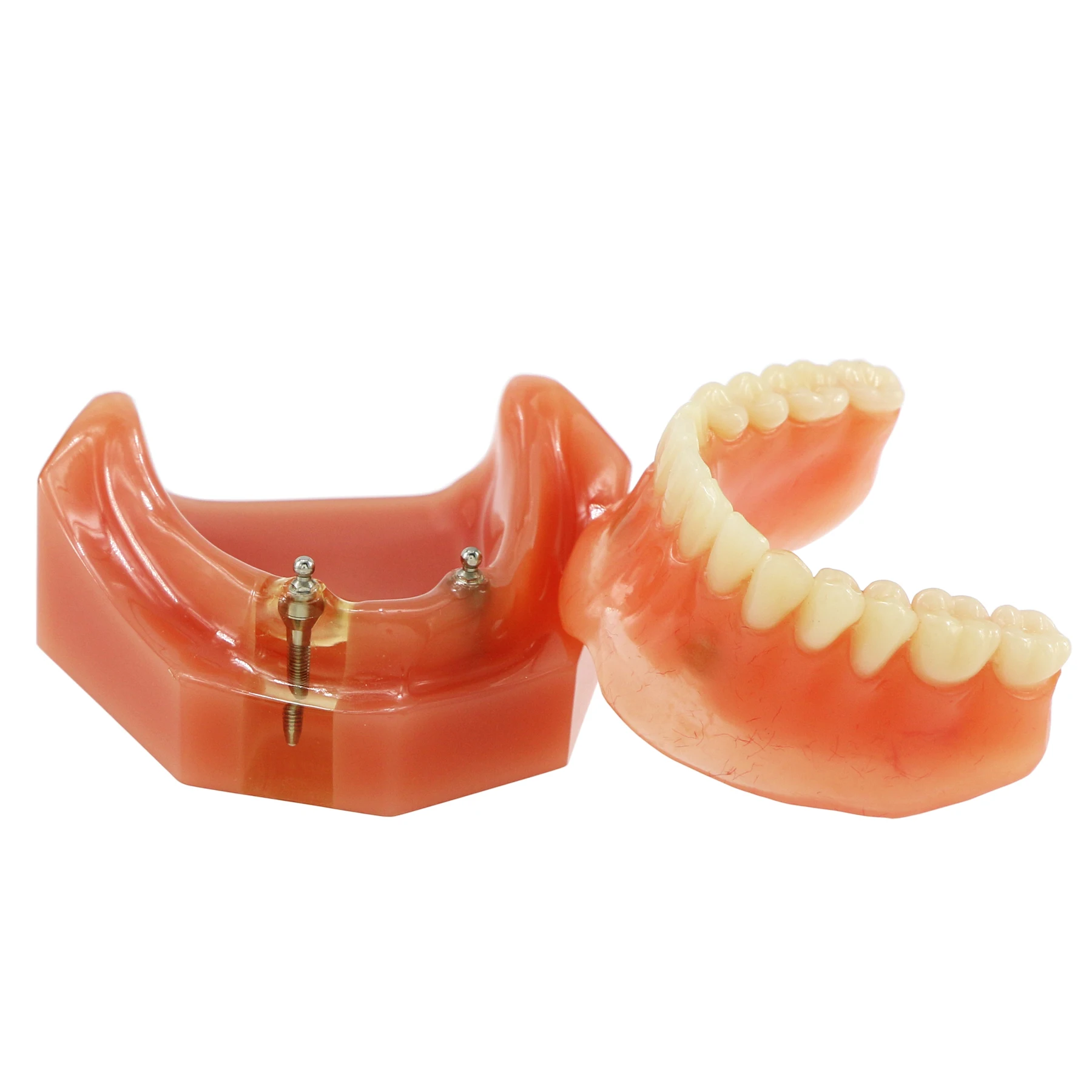 Зубной имплантат Overdenture, модель 2, имплантаты, низкое качество, метод восстановления, демонстрация для обучения